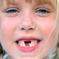 پکیج تخصصی کشيدن دندان قدامی شيری